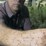 Ants crawling up Tom Rasberry's arm